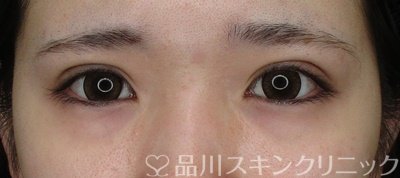 症例NO.69303のAFTER写真