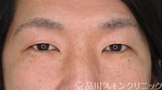 症例NO.50154のBEFORE写真