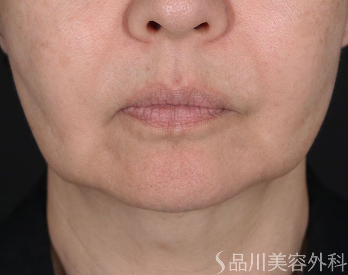 症例NO.71708のBEFORE写真