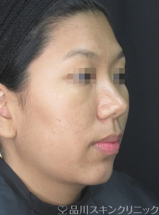 症例NO.71867のAFTER写真