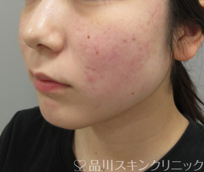 症例NO.73809のAFTER写真