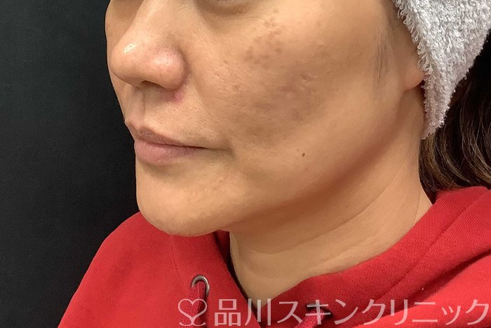 症例NO.69667のBEFORE写真