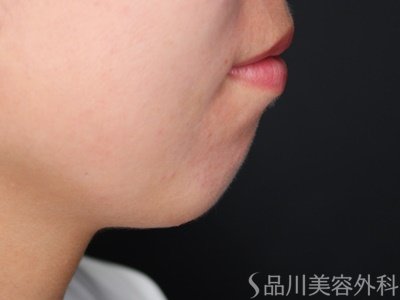 症例NO.65039のBEFORE写真