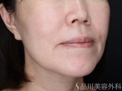 症例NO.72315のBEFORE写真