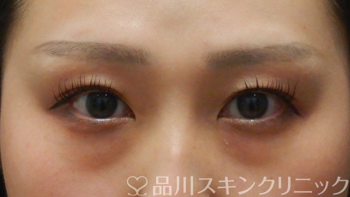 症例NO.64444のBEFORE写真
