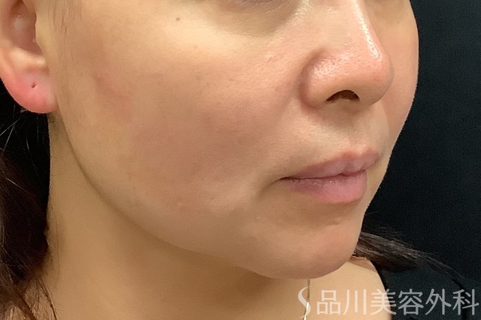 症例NO.71245のBEFORE写真