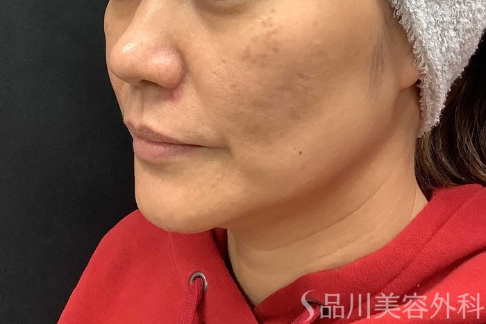 症例NO.69667のBEFORE写真