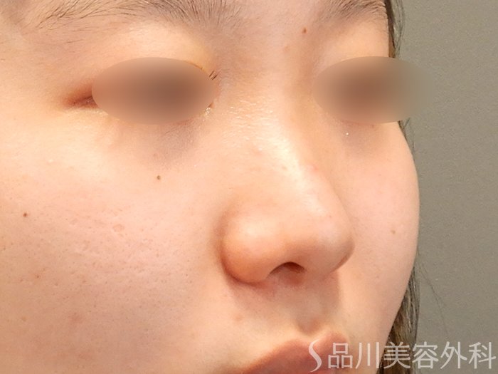 症例NO.71910のBEFORE写真