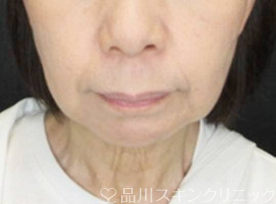 症例NO.74669のBEFORE写真