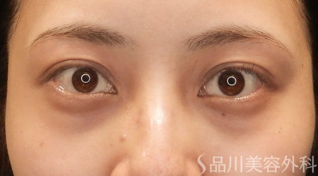 症例NO.74746のBEFORE写真