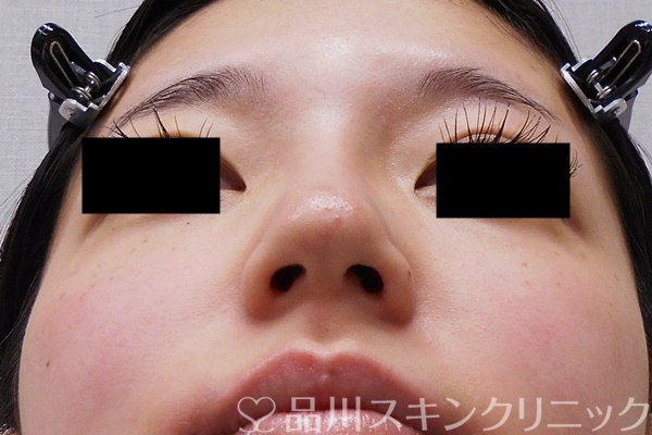症例NO.69564のBEFORE写真