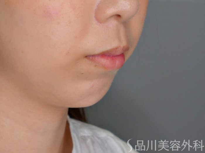 症例NO.70522のBEFORE写真