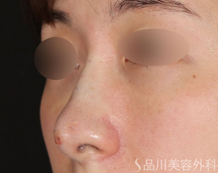 症例NO.72067のAFTER写真