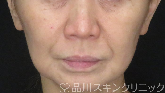 症例NO.70915のBEFORE写真