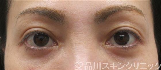 症例NO.60356のAFTER写真
