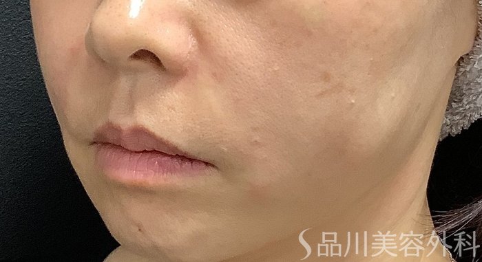 症例NO.75292のAFTER写真