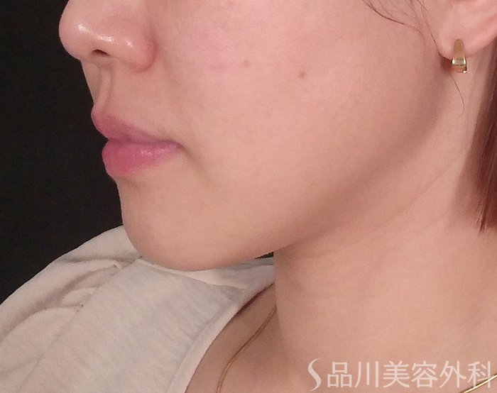 症例NO.69713のBEFORE写真