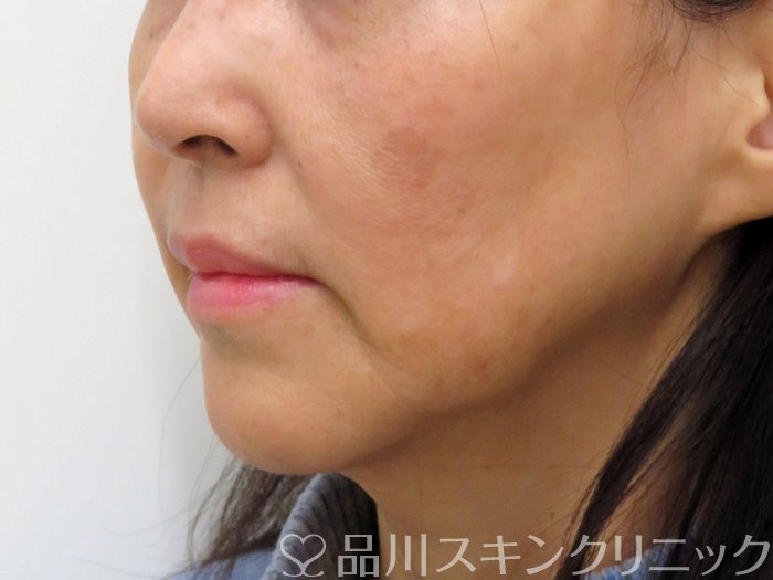 症例NO.73763のAFTER写真