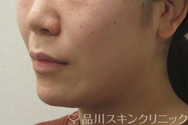 症例NO.74461のAFTER写真