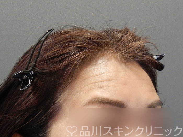 症例NO.72652のBEFORE写真