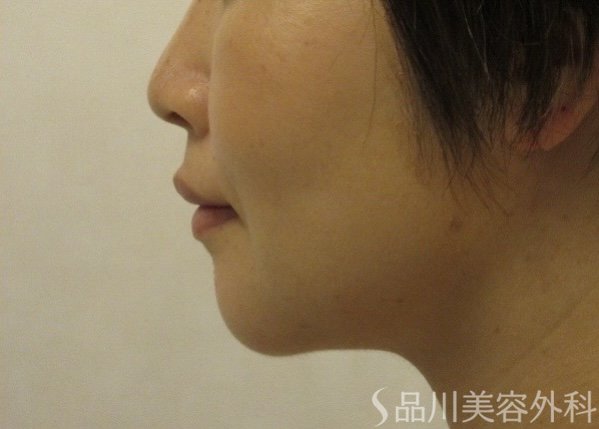 症例NO.74074のAFTER写真