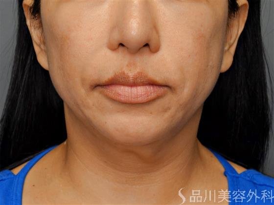 症例NO.57092のBEFORE写真