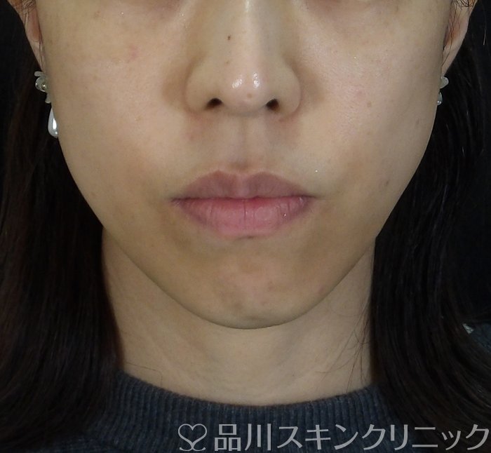 症例NO.67367のAFTER写真