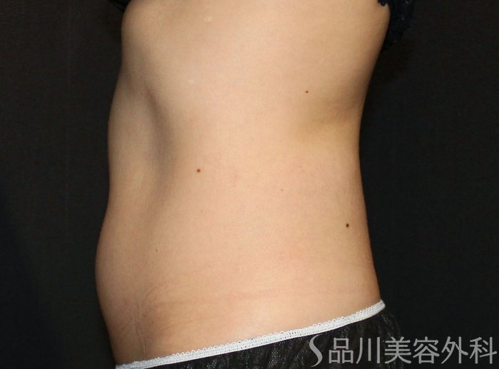 症例NO.74707のAFTER写真
