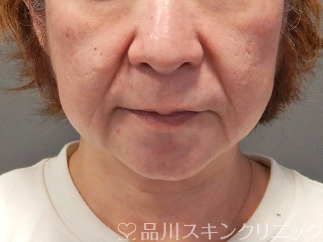 症例NO.75056のBEFORE写真