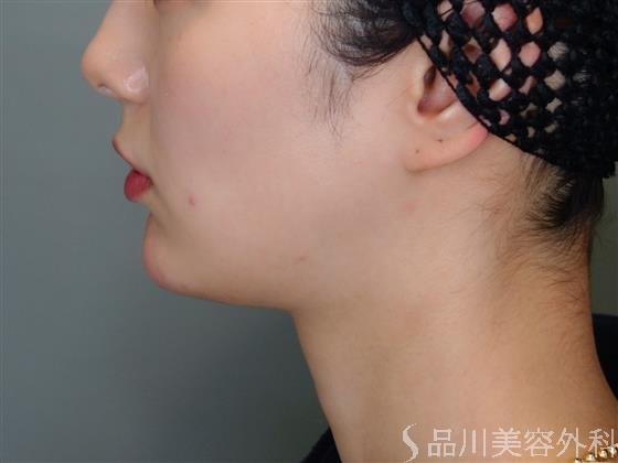 症例NO.50832のAFTER写真