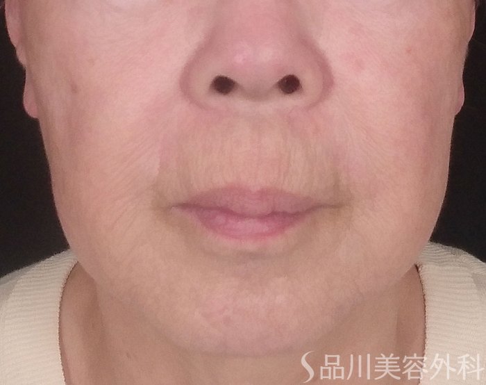 症例NO.70636のBEFORE写真