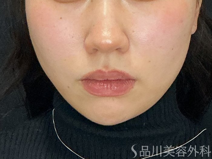 症例NO.72916のAFTER写真