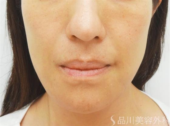 症例NO.30986のAFTER写真
