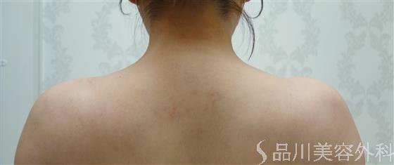 症例NO.54509のBEFORE写真