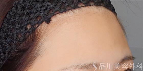 症例NO.51874のBEFORE写真