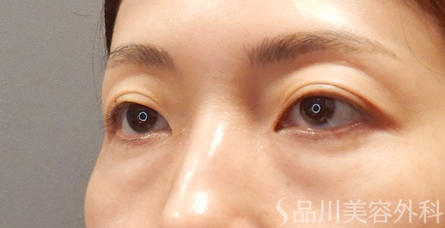 症例NO.73999のBEFORE写真