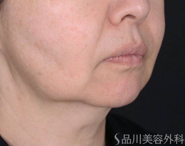 症例NO.71708のBEFORE写真