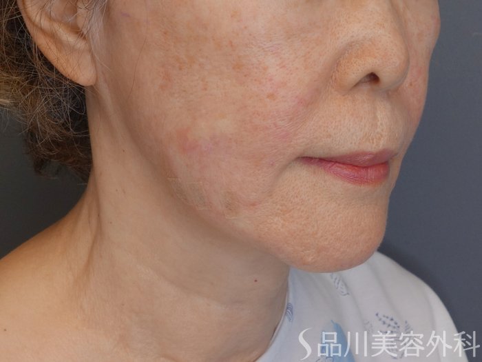 症例NO.71751のAFTER写真