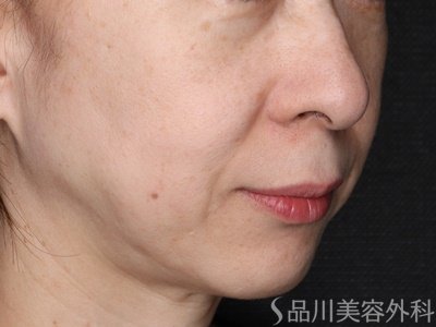 症例NO.72700のBEFORE写真