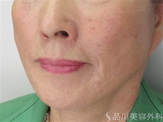 症例NO.46409のAFTER写真
