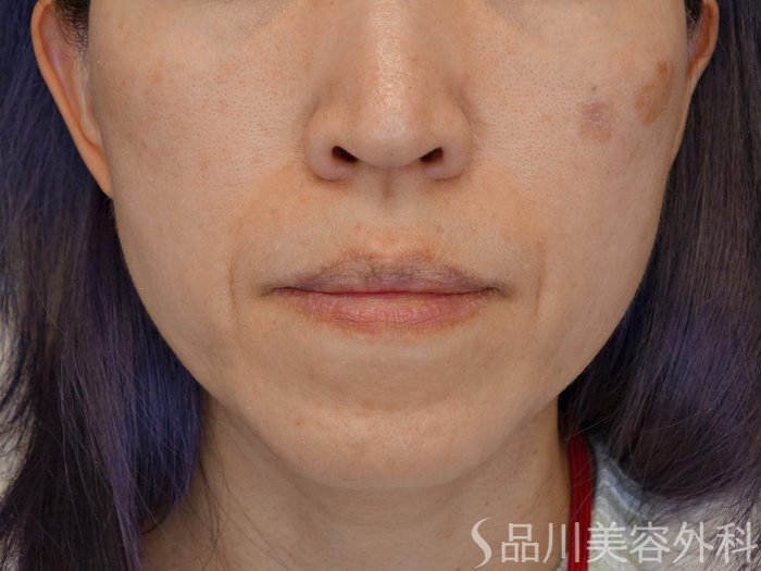 症例NO.74211のBEFORE写真
