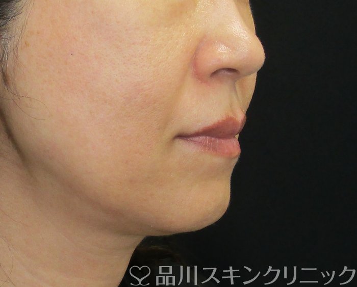 症例NO.73595のBEFORE写真