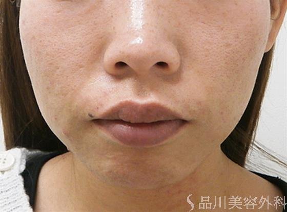 症例NO.31582のAFTER写真