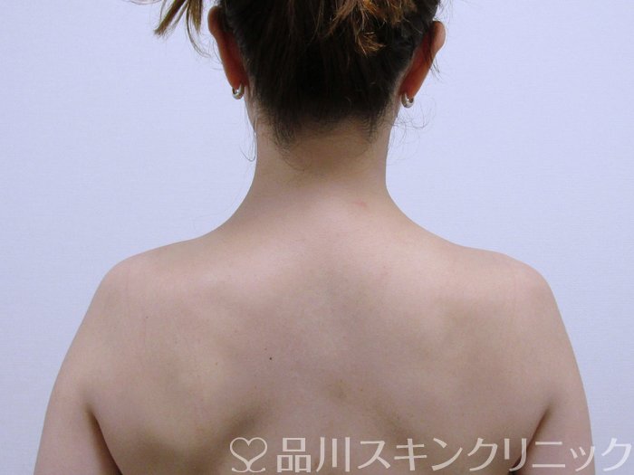 症例NO.74656のAFTER写真