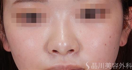 症例NO.56190のAFTER写真