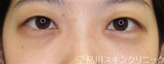 症例NO.61851のBEFORE写真