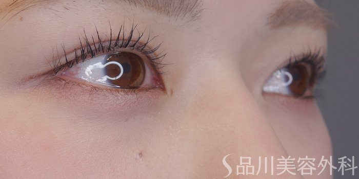 症例NO.72070のBEFORE写真