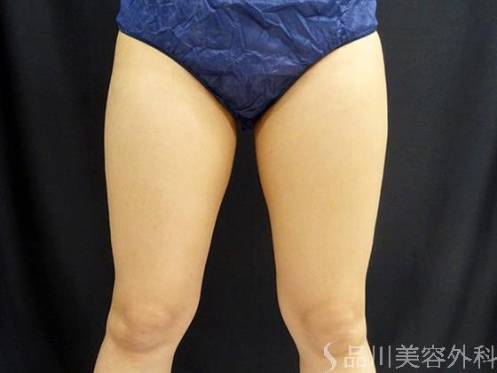 症例NO.52028のAFTER写真