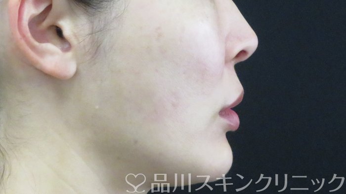 症例NO.71427のAFTER写真