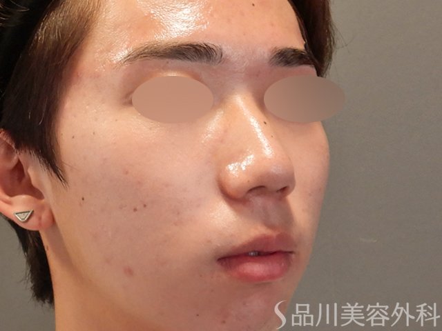 症例NO.74879のBEFORE写真